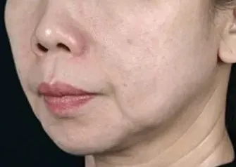 湘南美容クリニックのオンダリフトの症例1-2