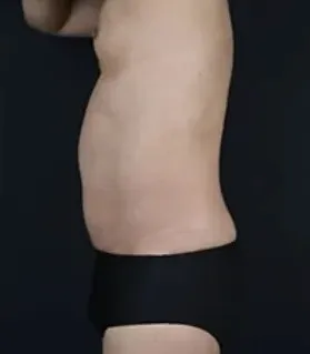 湘南美容クリニックのオンダリフトの症例3