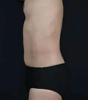 湘南美容クリニックのオンダリフトの症例3-2