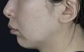 湘南美容クリニックのオンダリフトの症例2