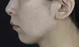 湘南美容クリニックのオンダリフトの症例2-2