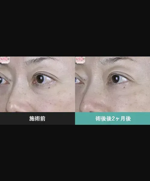 SBCのモフィウス8の症例