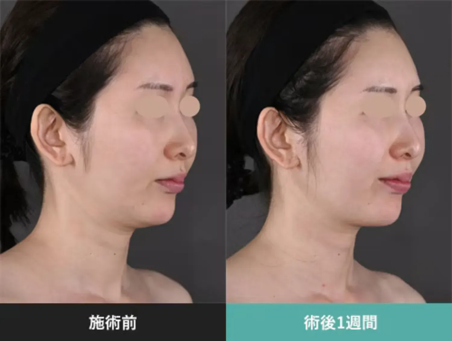 SBCのモフィウス8の症例