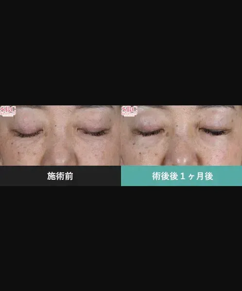 SBCのモフィウス8の症例