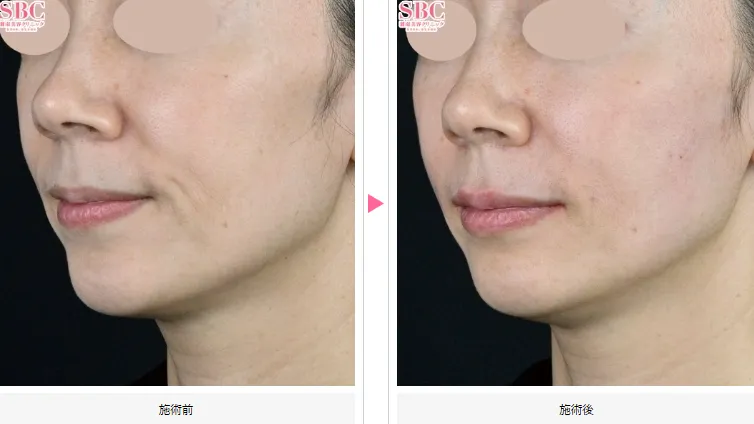 SBC湘南美容クリニックの4月の月替わりキャンペーン　ヒアルロン酸の症例写真