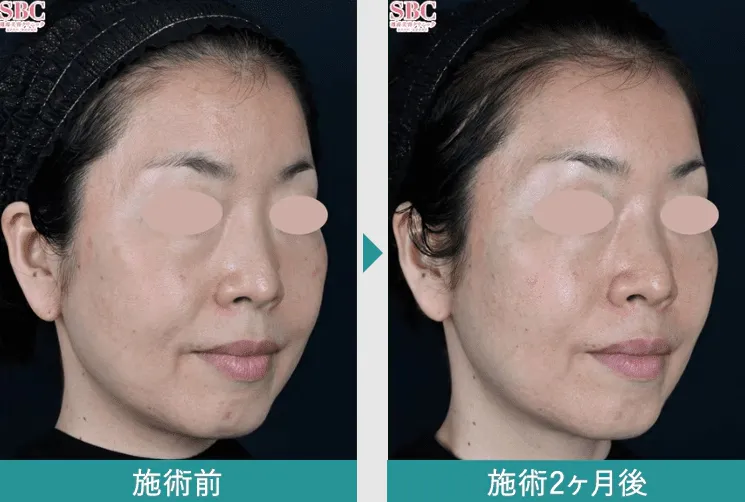 SBC湘南美容クリニックの4月の月替わりキャンペーン　デンシティの症例写真
