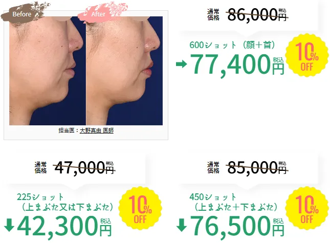 SBC湘南美容クリニックの4月の月替わりキャンペーン　デンシティの料金②