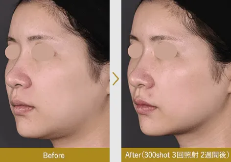 湘南美容クリニックの新・脂肪溶解リニアHIFUの症例写真1