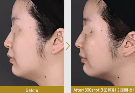 湘南美容クリニックの新・脂肪溶解リニアHIFUの症例写真2