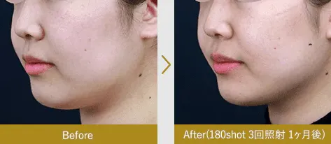 湘南美容クリニックの新・脂肪溶解リニアHIFUの症例写真3