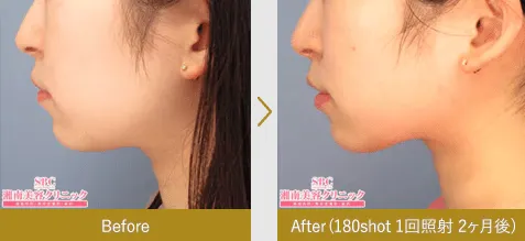 湘南美容クリニックの新・脂肪溶解リニアHIFUの症例写真4