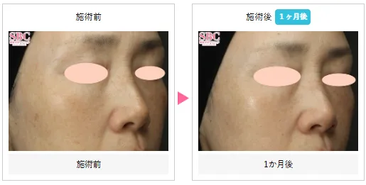 ピコレーザーの症例写真②
