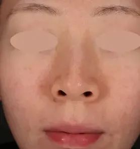 湘南美容クリニックのフォトフェイシャルの症例