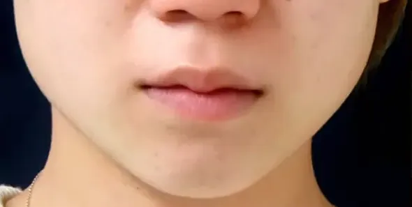 TCBの脂肪溶解注射の症例