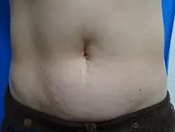 TCBの脂肪溶解注射の症例