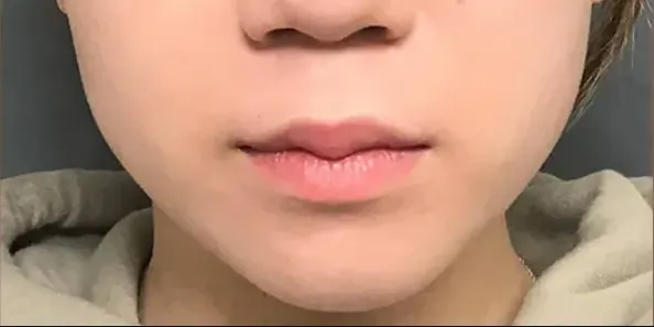 TCBの脂肪溶解注射の症例