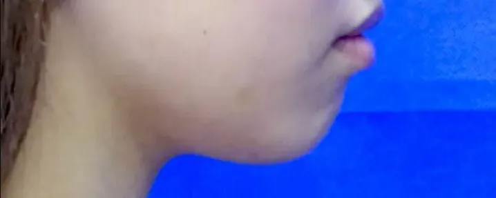 TCBの脂肪溶解注射の症例