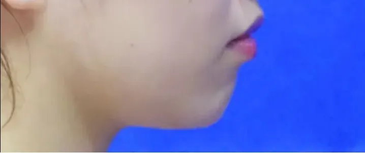 TCBの脂肪溶解注射の症例