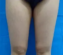 TCBの脂肪溶解注射の症例