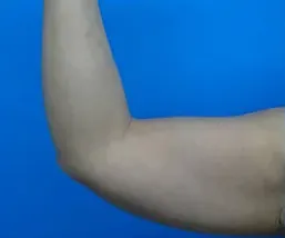 TCBの脂肪溶解注射の症例