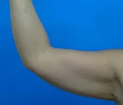 TCBの脂肪溶解注射の症例