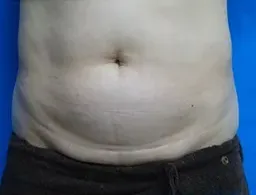 TCBの脂肪溶解注射の症例