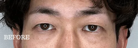 症例⑤ before