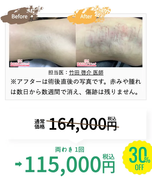 湘南美容クリニックのミラドライが30%OFF