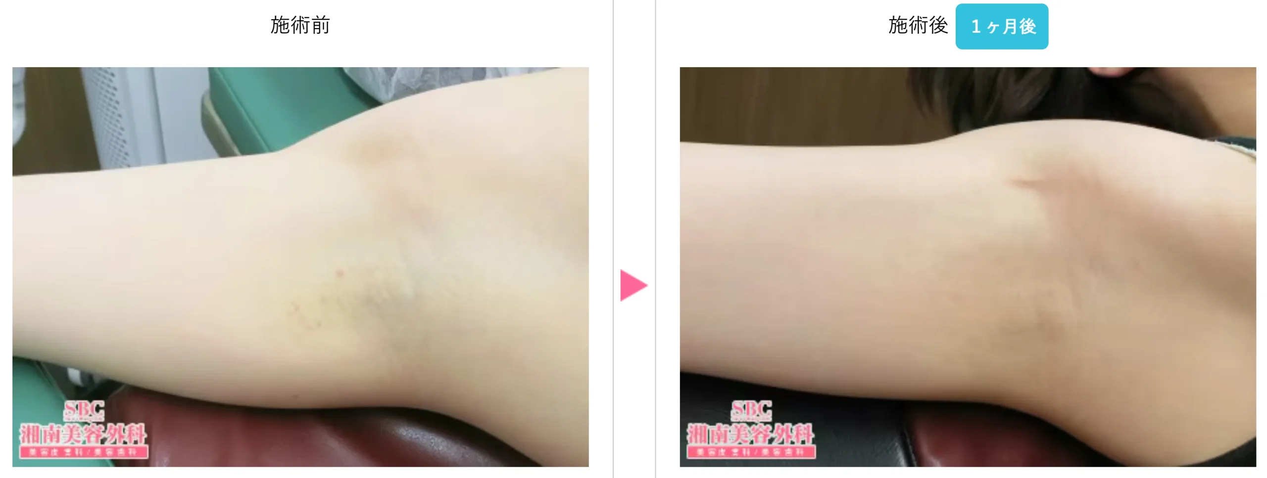 SBC湘南美容クリニックの5月の月替わりキャンペーン　ミラドライの症例写真