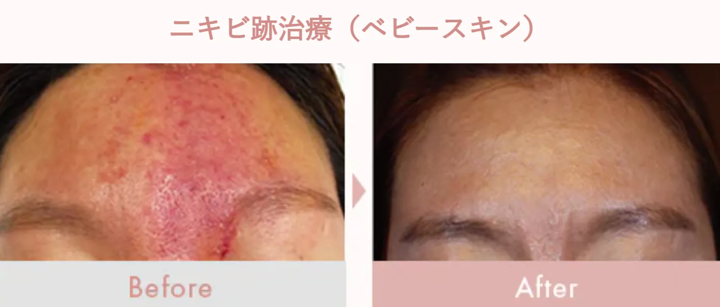 SBC湘南美容クリニックの5月の月替わりキャンペーン　レクトロポレーション（ベビースキン）の症例写真