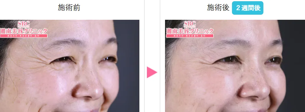 SBC湘南美容クリニックの5月の月替わりキャンペーン　ナチュラルボトックスの症例写真①