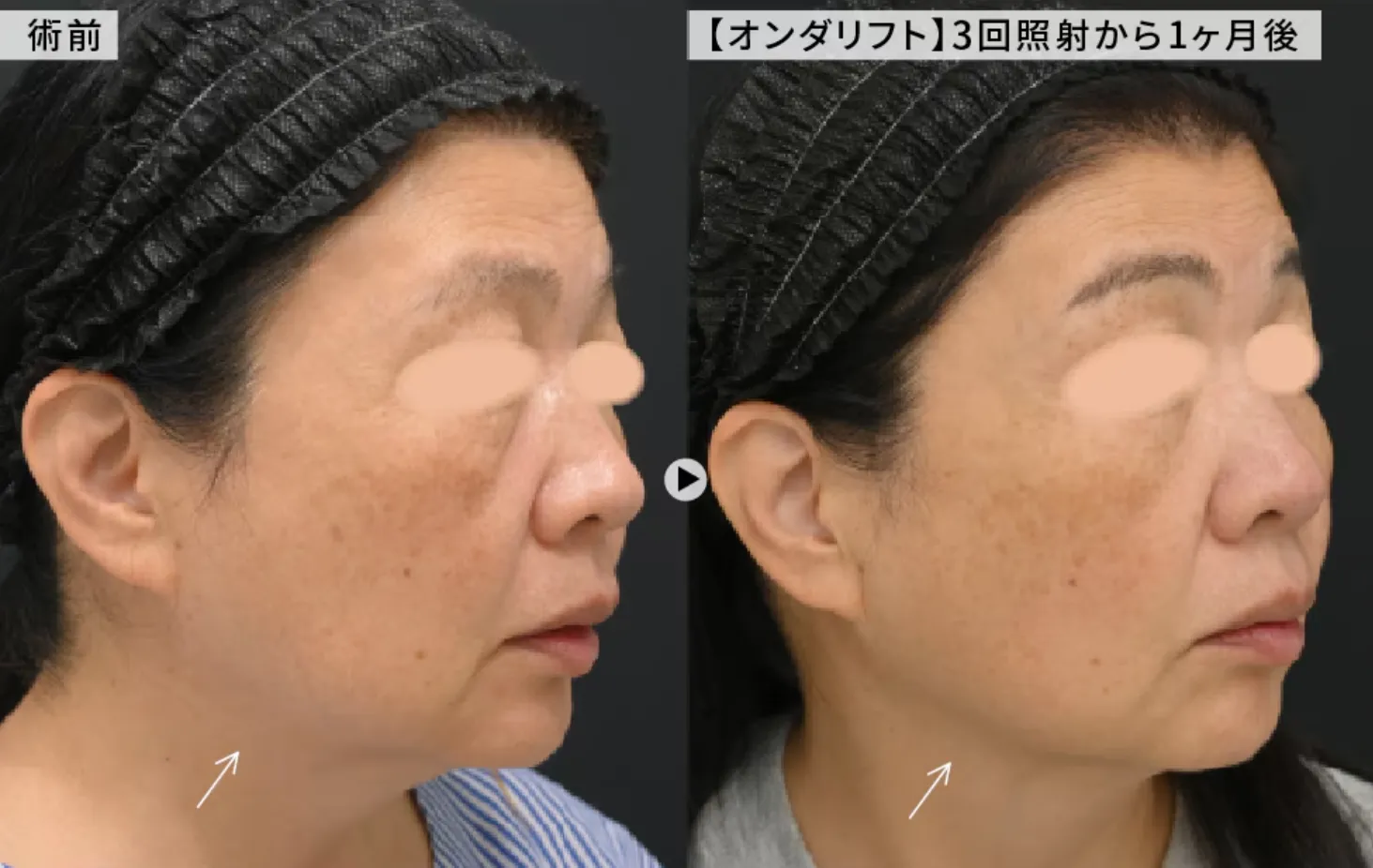 湘南美容クリニックのオンダリフトの症例写真