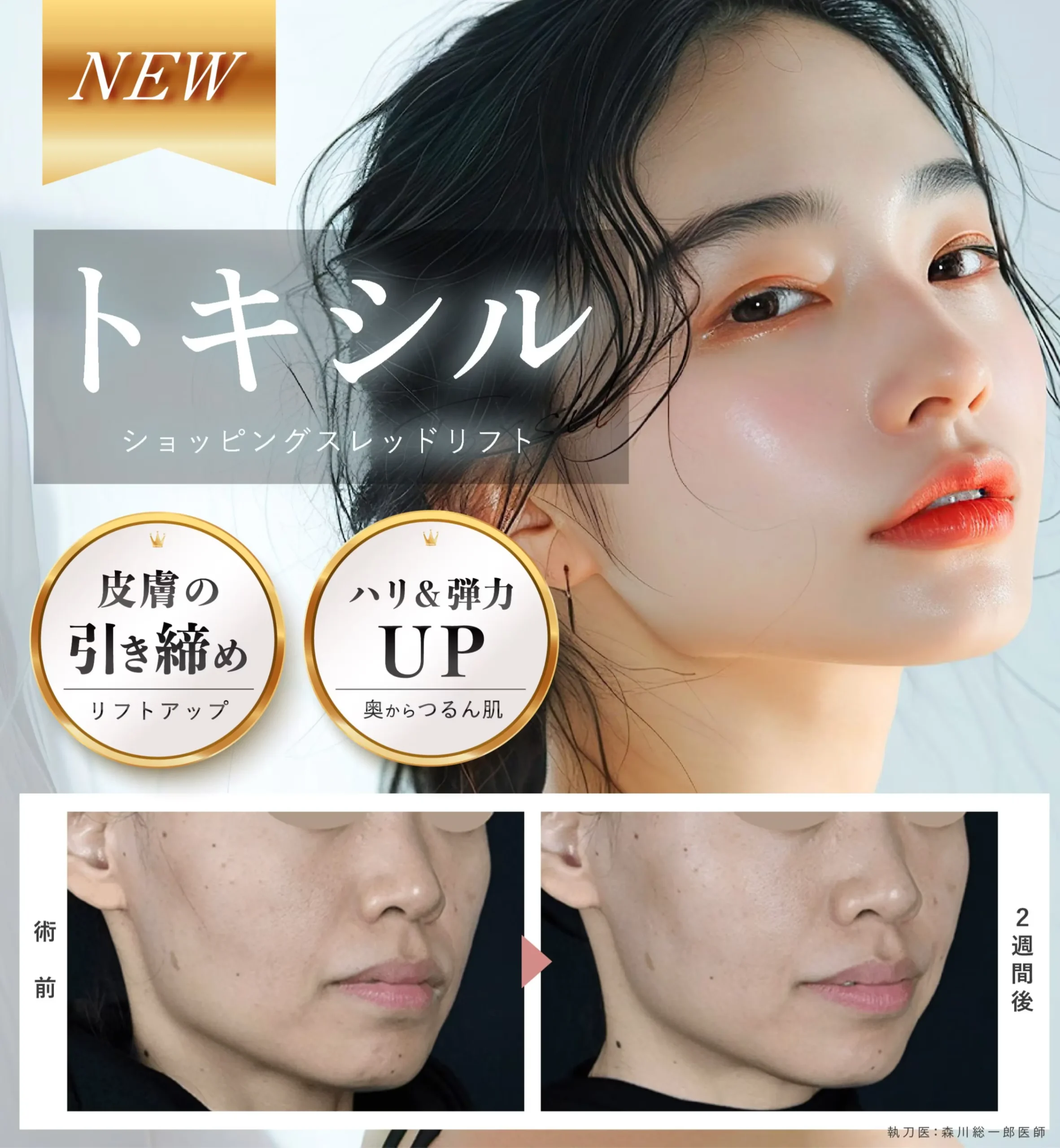 湘南美容クリニックのトキシルスレッドの効果と症例写真