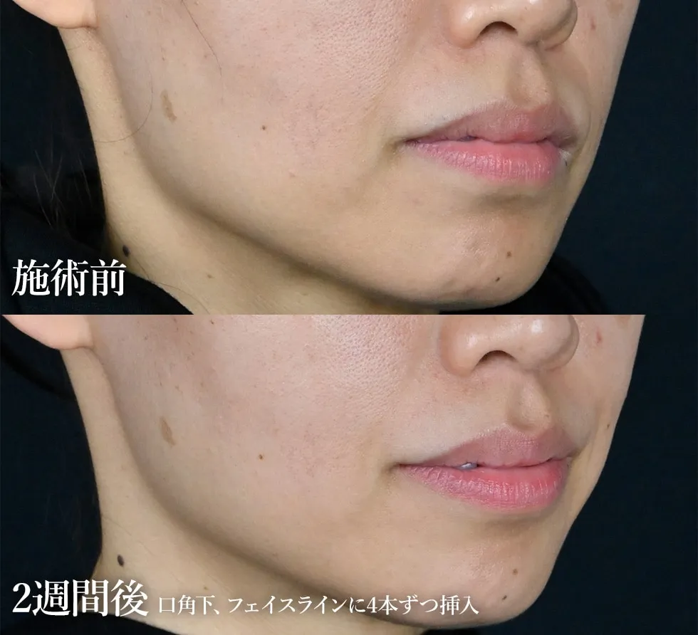 湘南美容クリニックのトキシルスレッドの症例写真