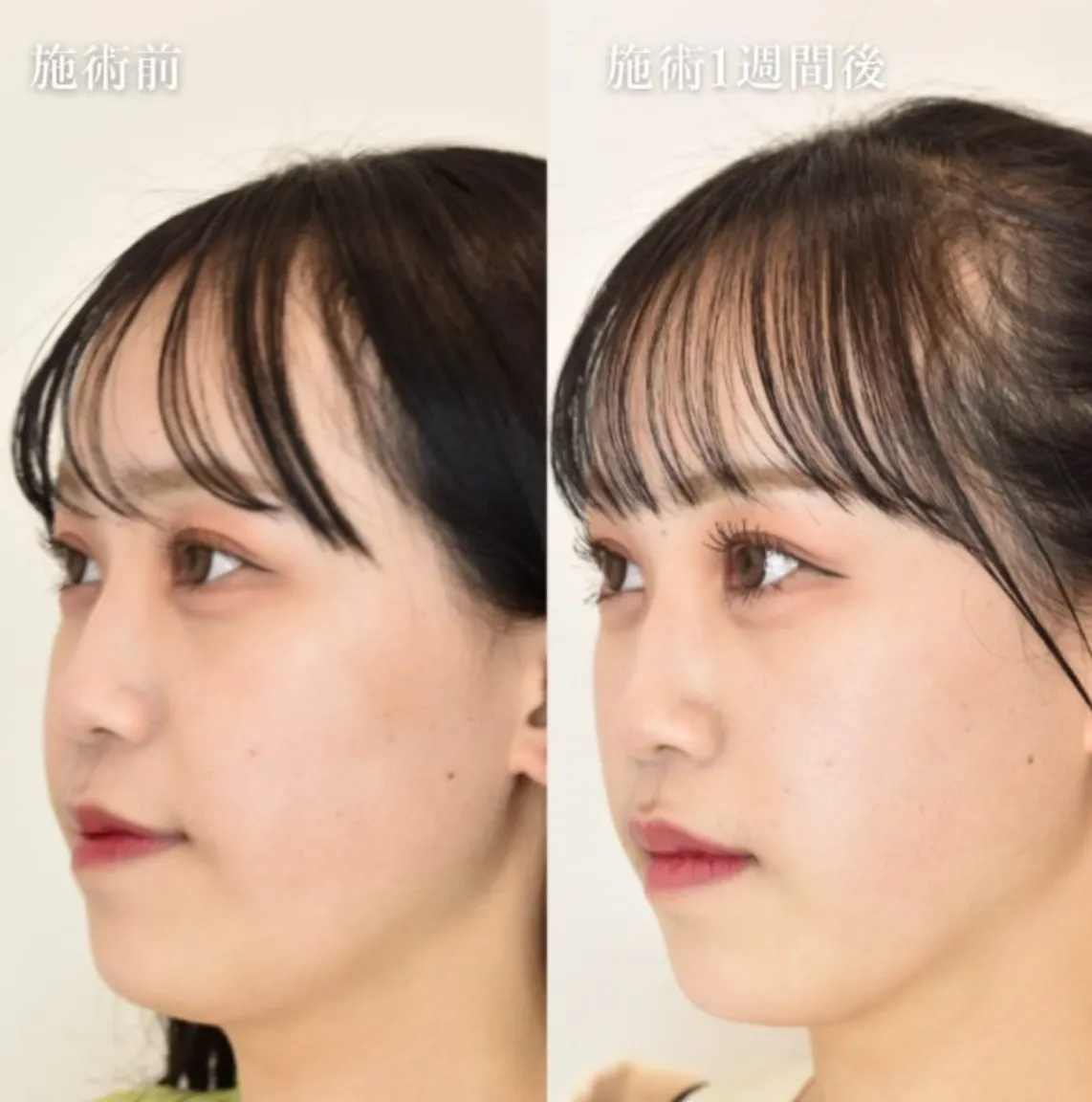 TCBのエラボトックス 施術前と施術1週間後の症例写真