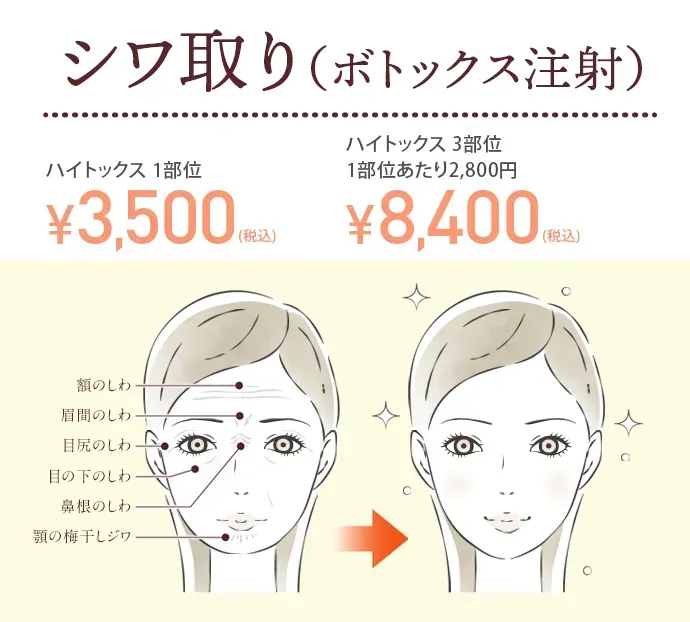 TCBのしわ取り