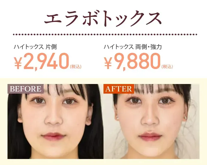 TCBのエラボトックス