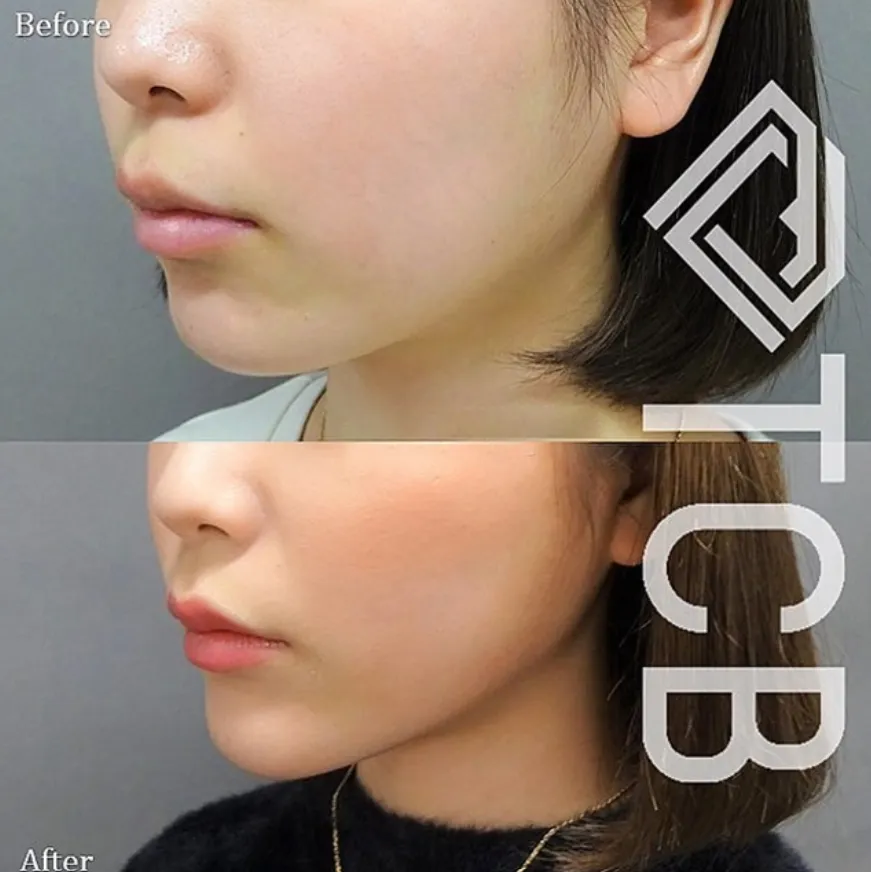 TCB ボトックスのビフォーアフター症例写真
