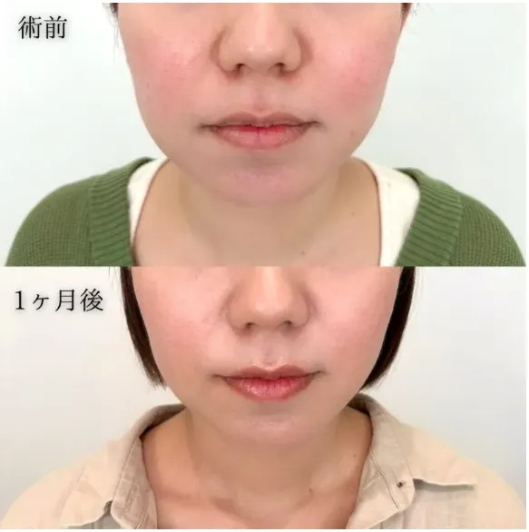 TCBのハイフ症例①