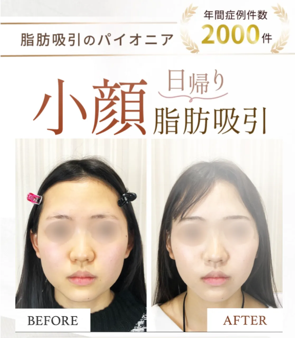 共立美容外科の顔痩せ脂肪吸引の金額がお得！