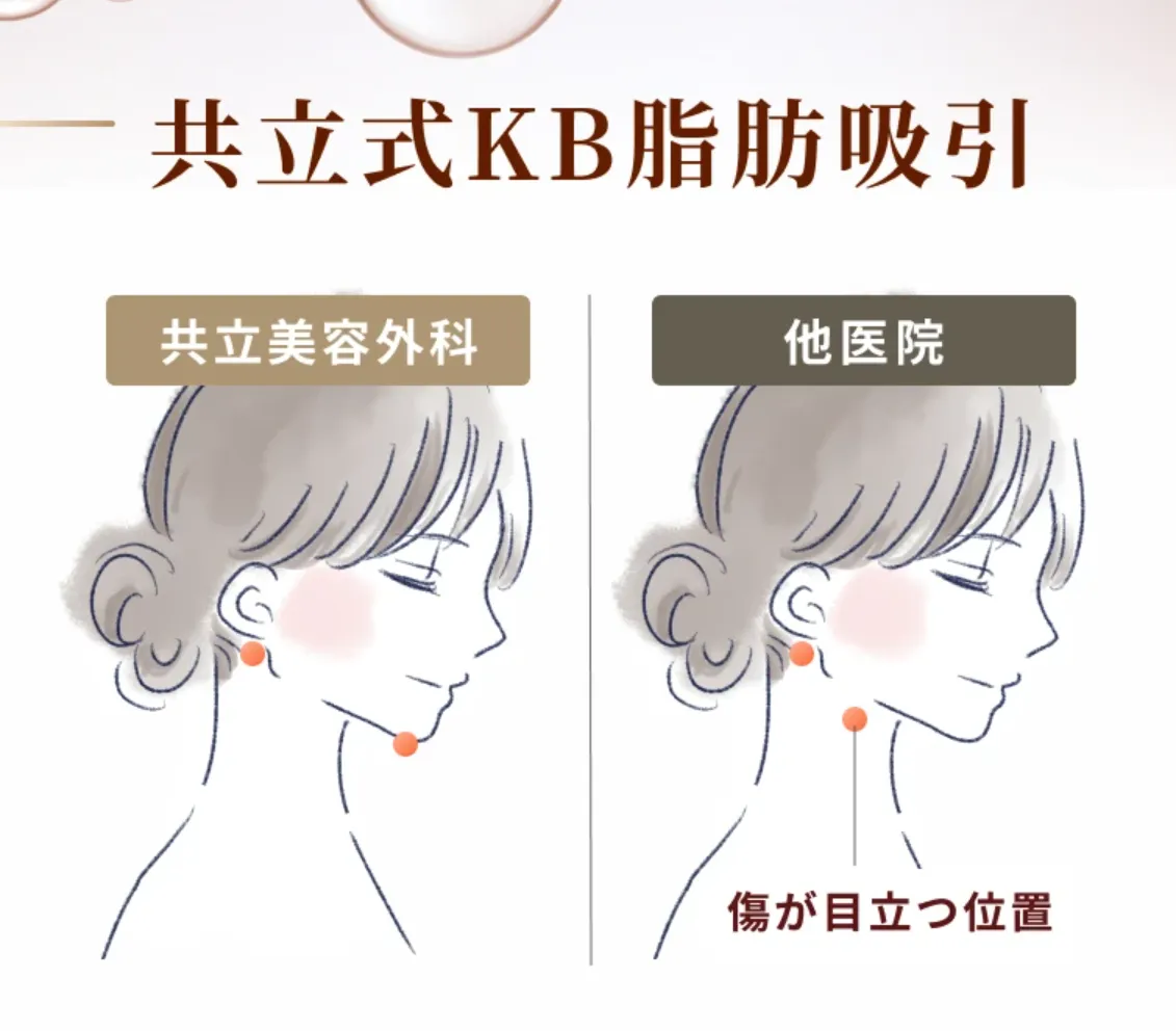 口コミ評判が良い脂肪吸引を受けられる共立美容外科は傷跡が目立たない