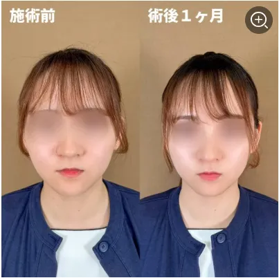 TCBの糸リフト症例②