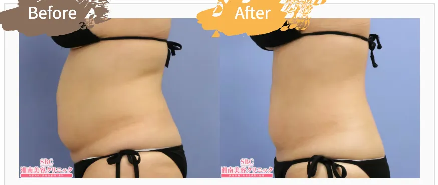 SBC湘南美容クリニックの6月の月替わりキャンペーン　クールスカルプティング®エリートの症例写真
