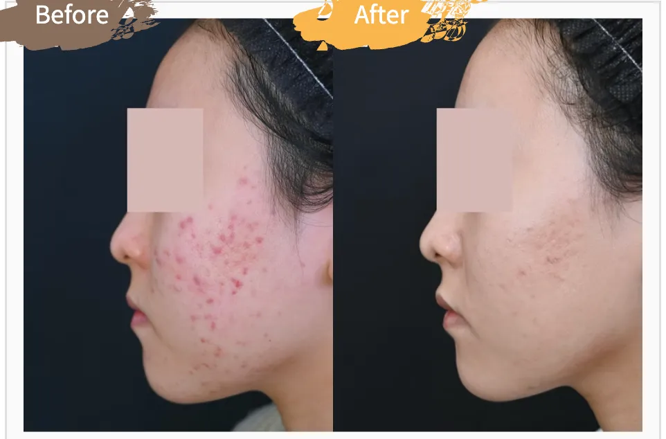 SBC湘南美容クリニックの6月の月替わりキャンペーン　アクネライトの症例写真①