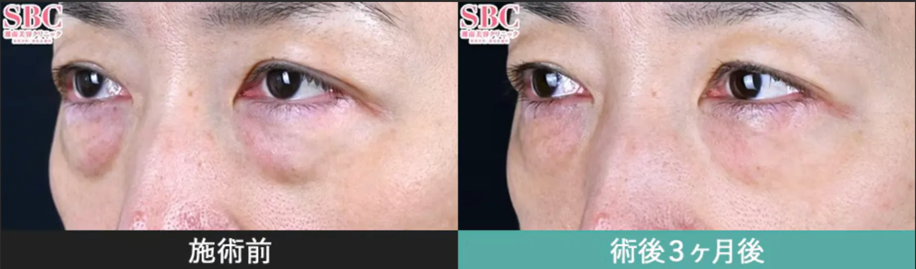 SBC湘南美容クリニックの6月の月替わりキャンペーン　モフィウス8（看護師照射）の症例写真①