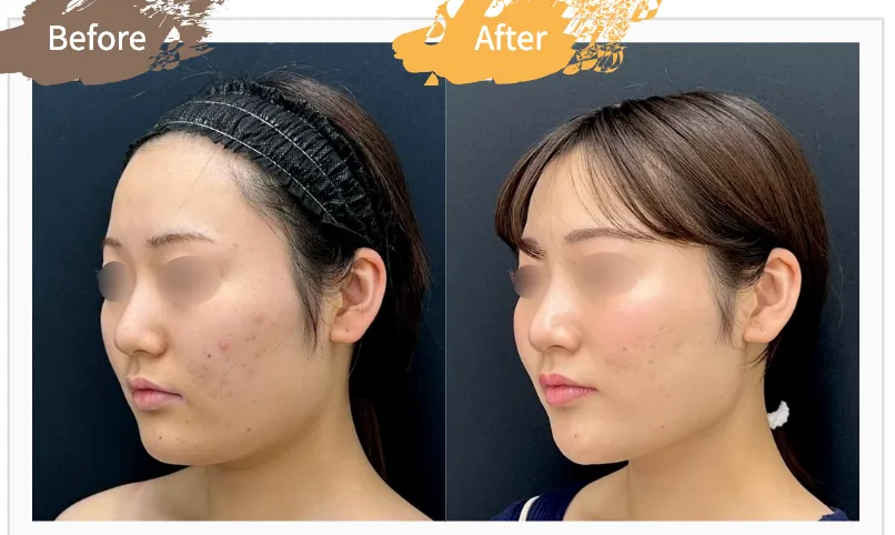SBC湘南美容クリニックの6月の月替わりキャンペーン　脂肪吸引注射顔の症例写真①