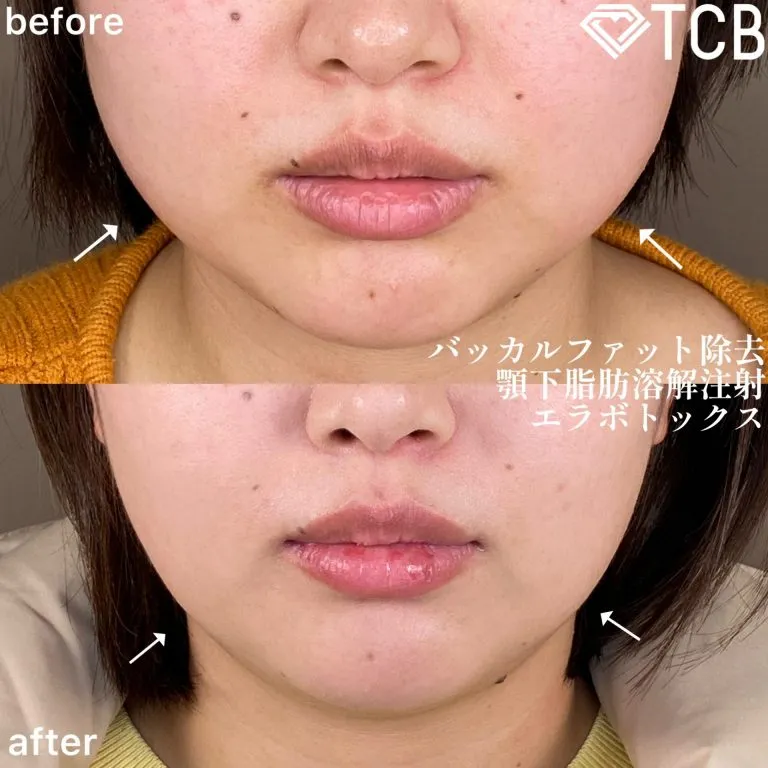脂肪溶解注射①