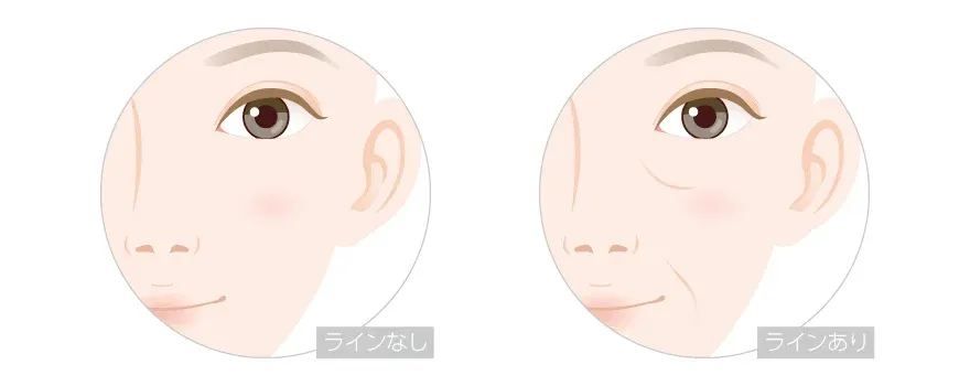 TCBのヒアルロン酸注入の料金は?溶かすのにも費用はかかる?TCBのヒアルロン酸注射は顔のシワを改善したい方におすすめ
