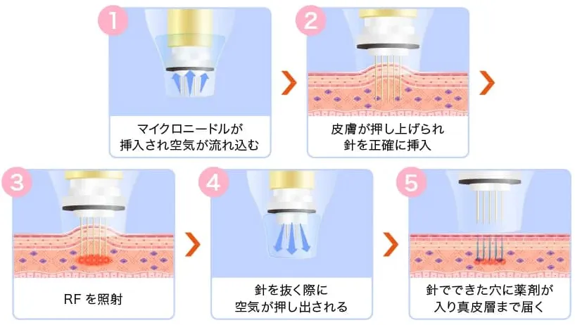 TCBのポテンツァはドラックデリバリーシステムを採用