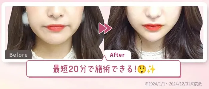 TCB小顔リフトは最短20分で施術完了